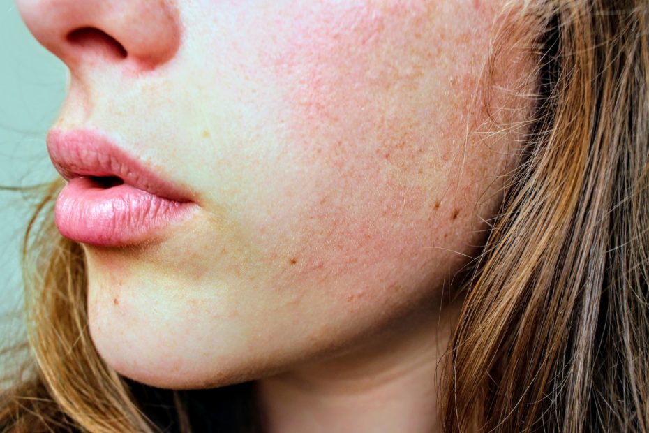 winter skin
